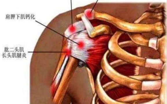 肌腱炎一般在什么位置图片
