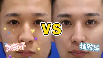 男性鼻子更应该有男人阳刚之气 肋软骨术后3年效果 形态稳定 术前鼻子鼻梁有驼峰且没有鼻尖表现点 我给许肋软骨3 2来做的鼻型 哔哩哔哩 Bilibili