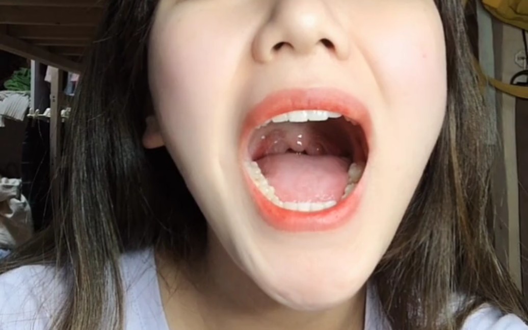 小提示:悬雍垂过长会引起异物感,恶心感.睡觉容易打鼾.