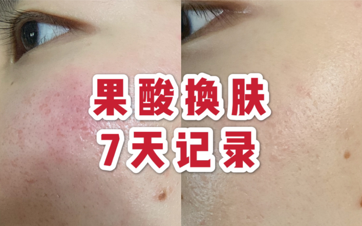 果酸换肤记录帖敏感肌也能刷酸医美刷酸7天记录敏感肌祛痘印康康肌肤