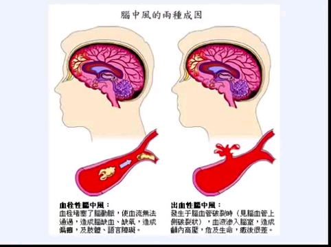 中风康复的4种关键营养哔哩哔哩bilibili