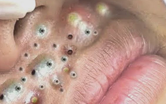 满脸的蛆宝宝割脸吧