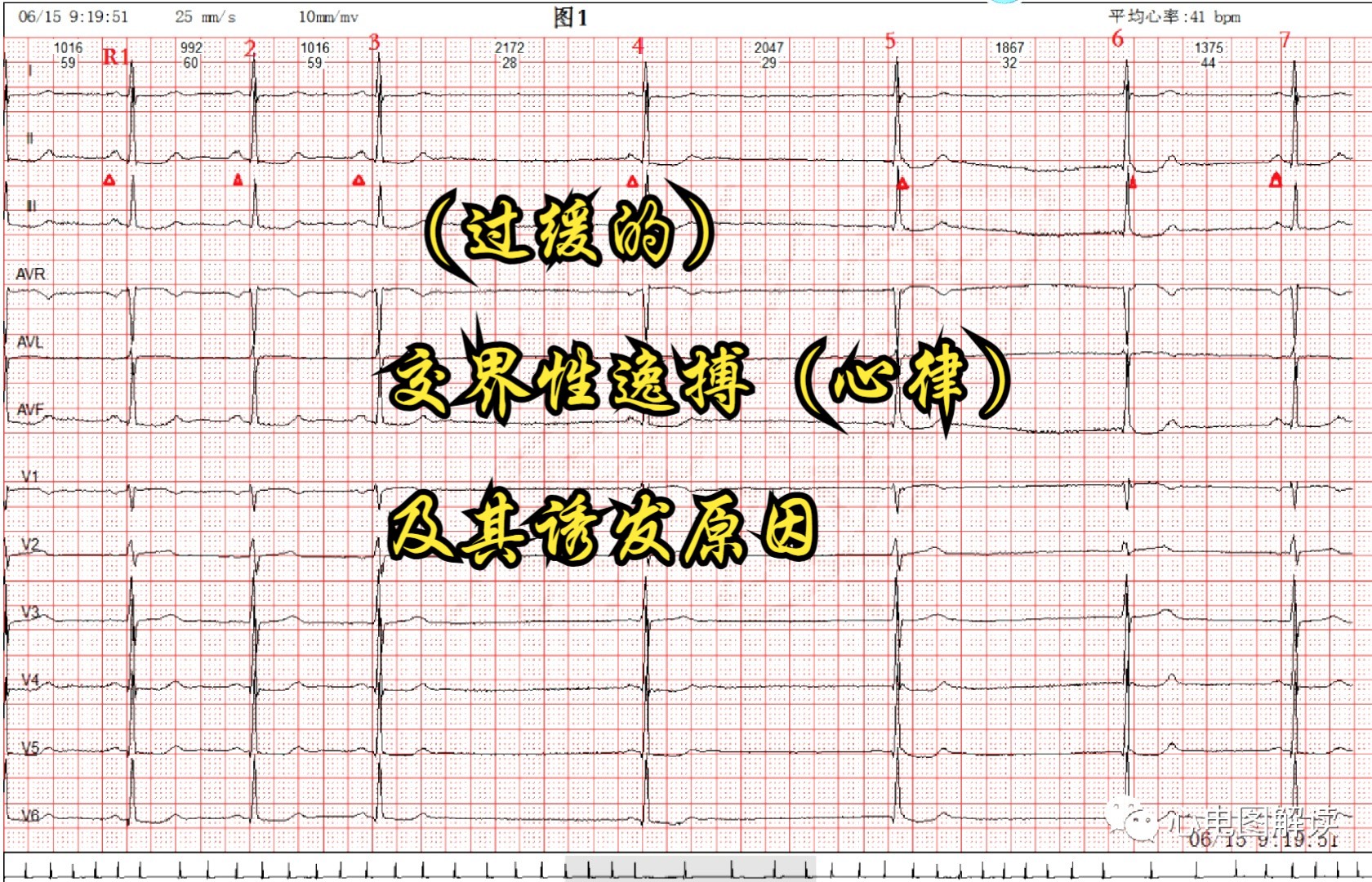 (过缓的)交界性逸搏(心律)及其诱发原因哔哩哔哩bilibili