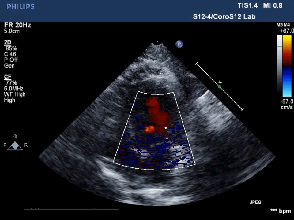 二尖瓣关闭不全彩超图片