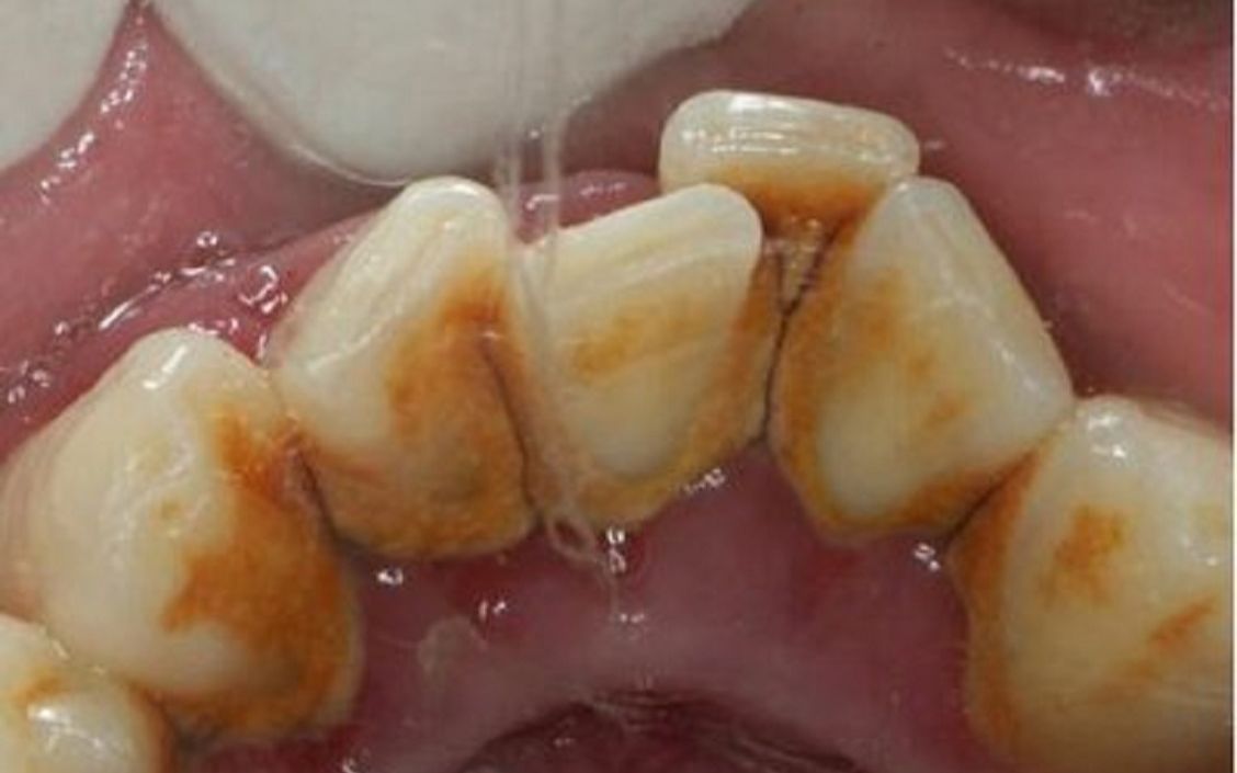 牙黄牙结石速来!做对牙粉功课才不当冤大头,牙齿一月恢复洁白!