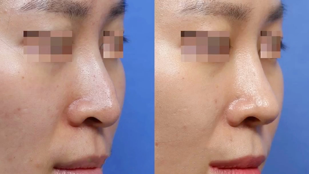 术前隆鼻的假体断层造成鼻头下垂(我通过肋软骨给她重新做了鼻梁和