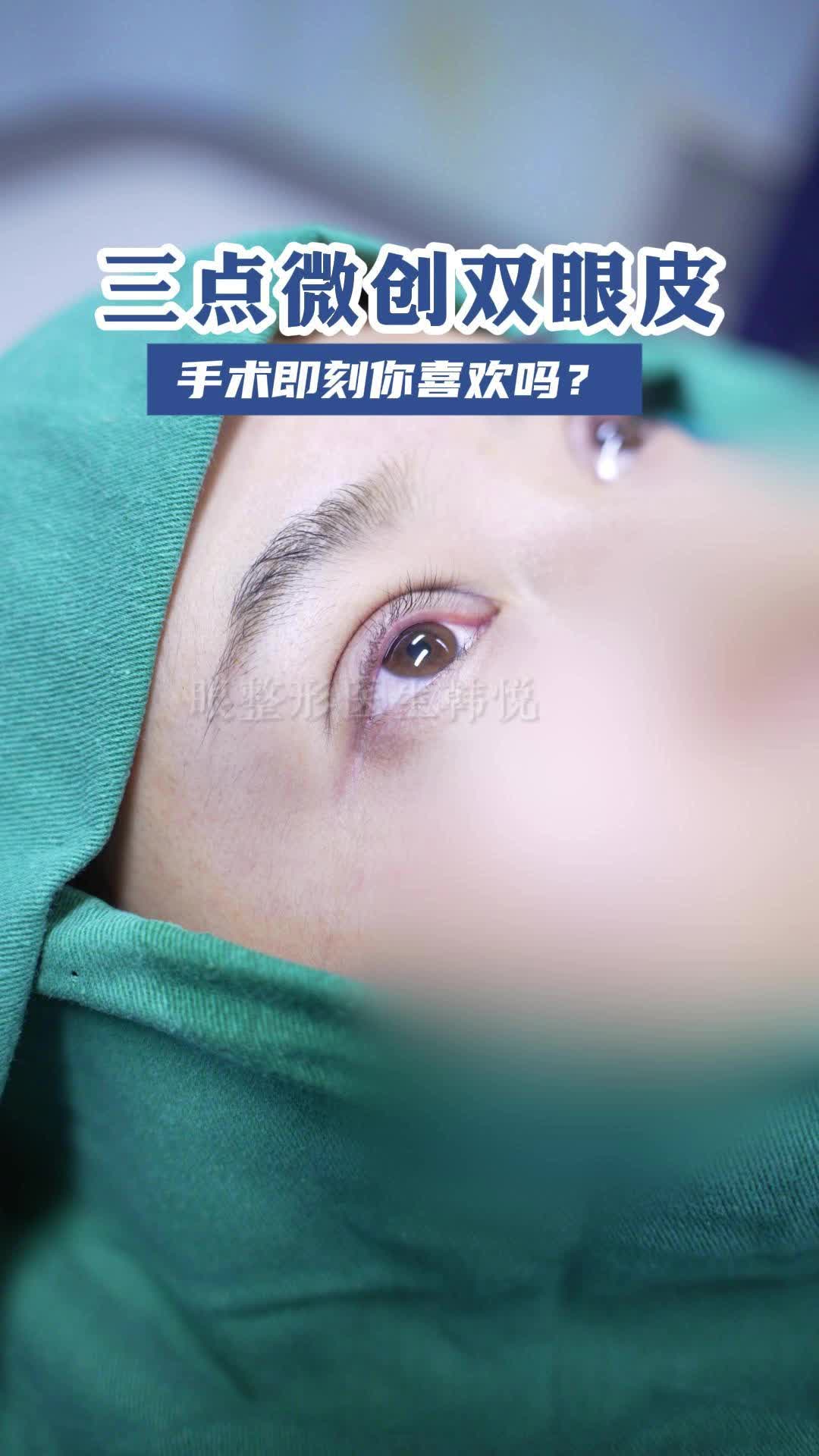 三点微创双眼皮术后即刻!