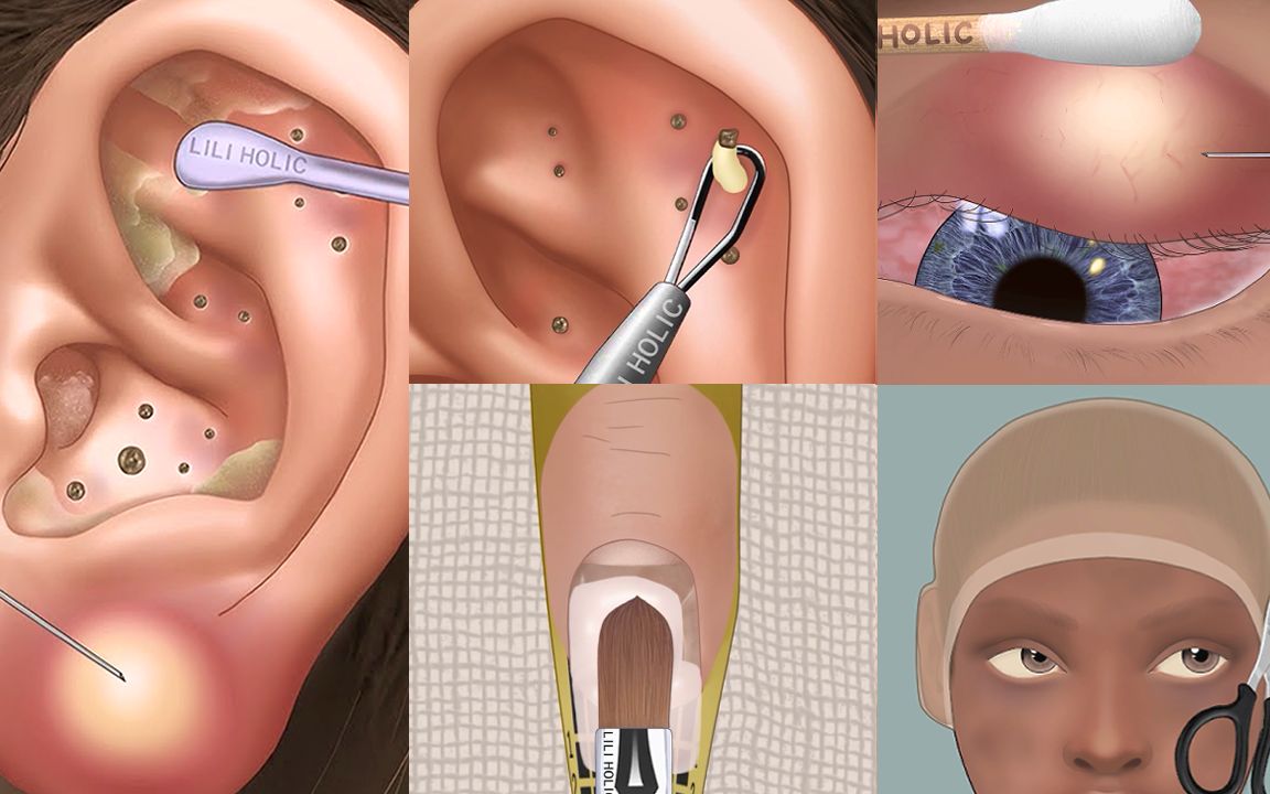 [图]解压合集 | 眼部护理 | 耳朵粉刺清理 | 指甲修复过程 | 美妆改造