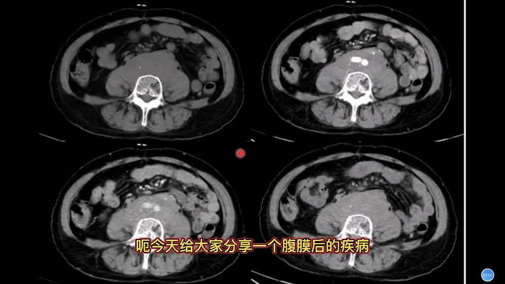 腹膜后典型肿瘤病例分享,放射科医生讲解,典型征象解读哔哩哔哩bilibili