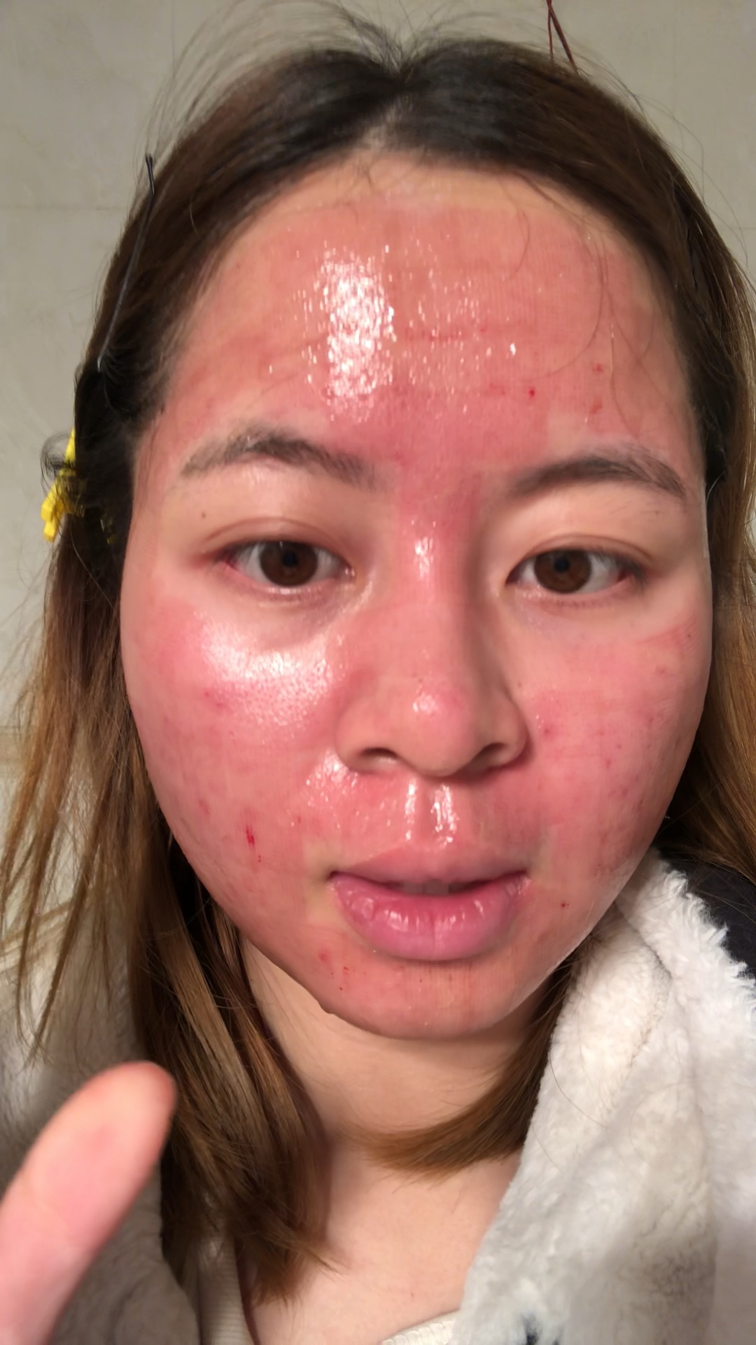 点阵激光第一天[大哭]煮熟了的鸡蛋