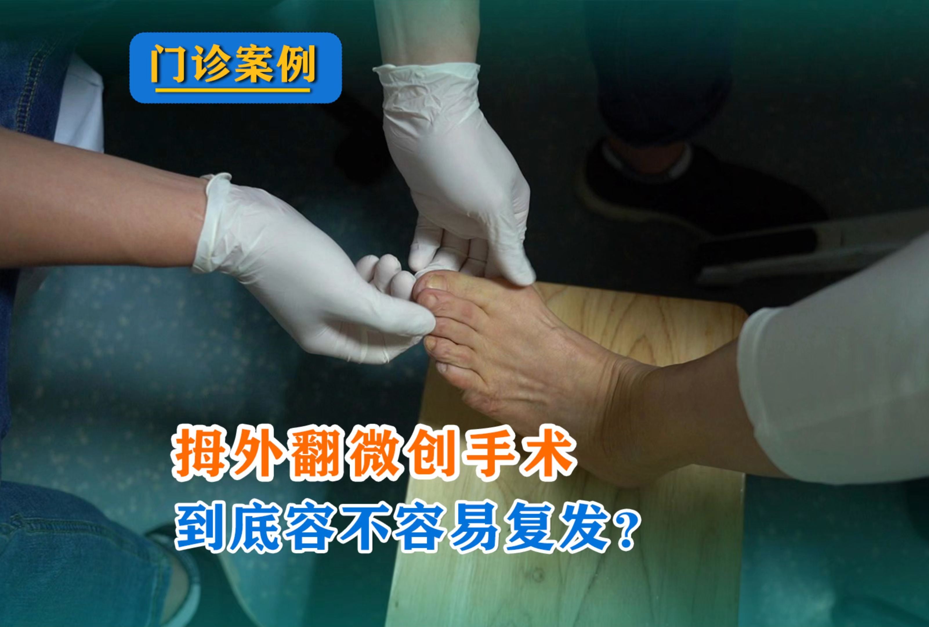 拇外翻微创手术到底容不容易复发