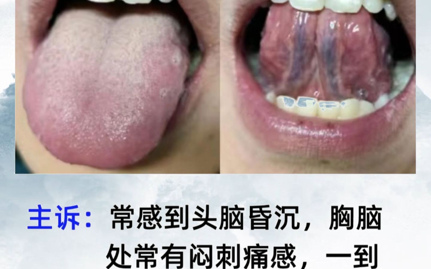 舌下青筋紫黑单活血化瘀没用!