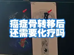 Download Video: 七旬阴茎癌患者外院术后12年，出现多发骨转移，手术前需要化疗吗？