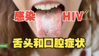 Download Video: 感染了艾滋病病毒后的舌头和口腔症状