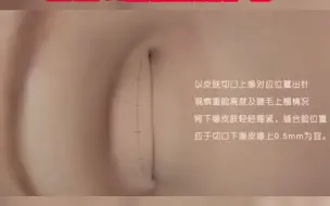 Tải video: 全切双眼皮如何去脂去皮的？一个视频告诉你答案