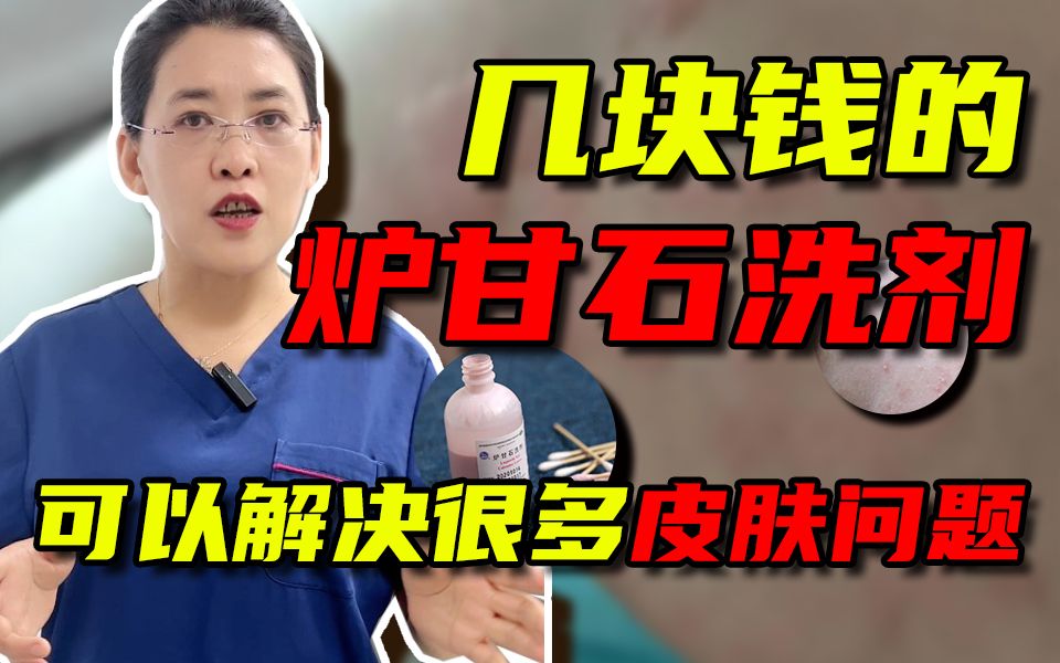 [图]你用过炉甘石洗剂吗？这些妙用，你get到了几个？