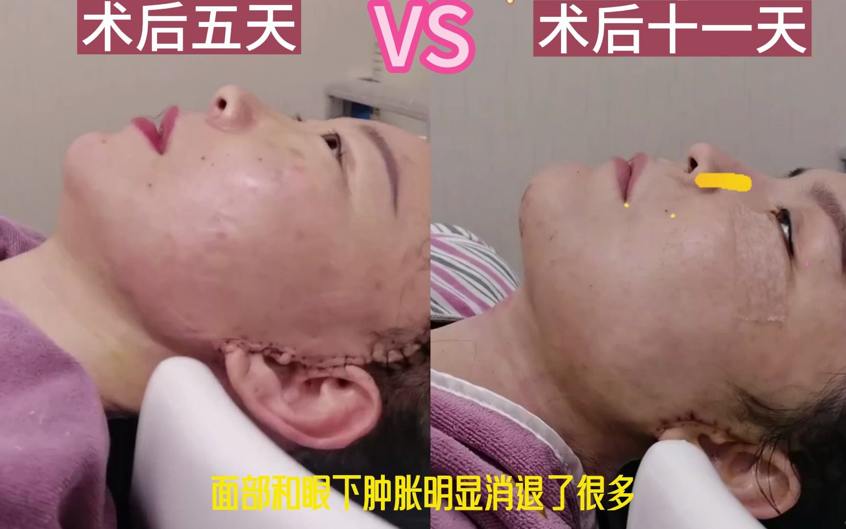 拉皮术后恢复实况对比:5天vs11天,从不人不鬼到青春少女
