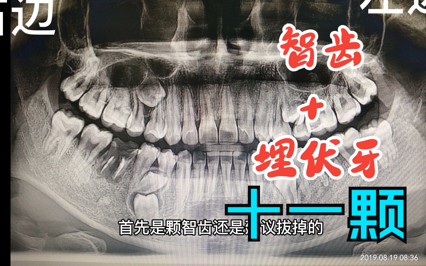 【智齿奇葩说】智齿加埋伏牙,总共要拔除11颗牙齿,悲催的人生哔哩哔哩bilibili