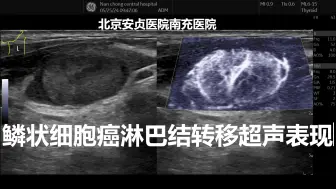 Tải video: 鳞状细胞癌转移性淋巴结多表现为类圆形，皮髓质分界不清，伴有坏死，未坏死部分血流信号丰富，失去门样血流，检查时应仔细询问有无咳嗽，吞咽困难，有无耳鸣，回缩涕带血。