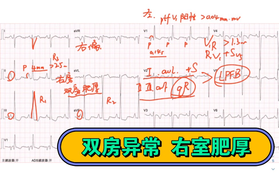 竇性心律 2.雙房異常 3.電軸右偏 4.順鐘向轉位 5.提示右室肥厚 6.