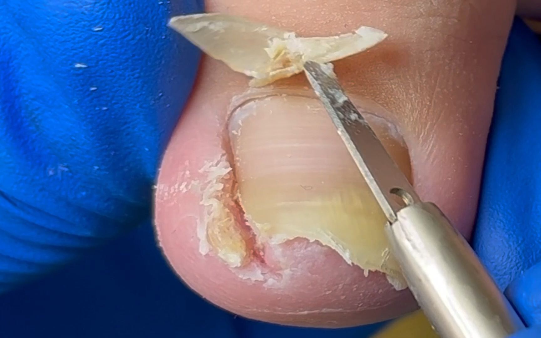 两个脚趾甲也太卷了!【刘一刀修脚 解压】