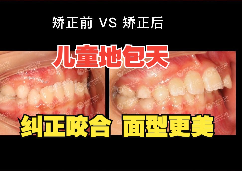 【牙齿矫正】儿童地包天越早矫正,效果越明显