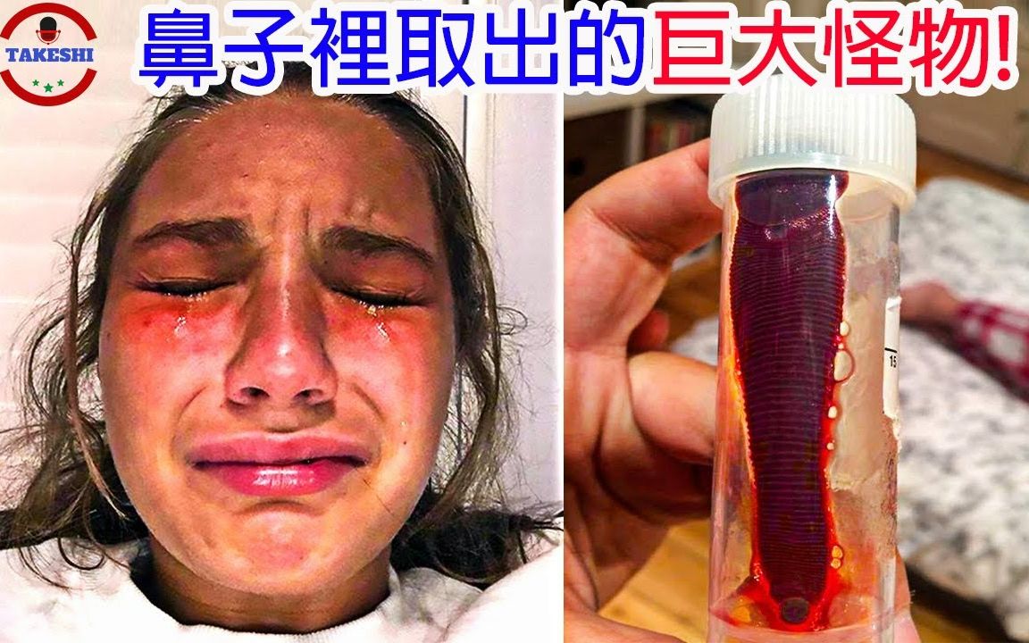 [图]TOP2]数个从人体取出的骇人"怪物"|经历22年所养成的巨型怪物|令医生惧怕的体内巨物|搬运