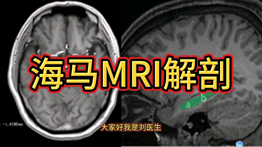 影像基础:海马MRI解剖分享讲解,2分钟学会! - 哔哩哔哩