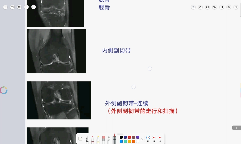 影像读片复盘 膝关节半月板损伤 MRI哔哩哔哩bilibili