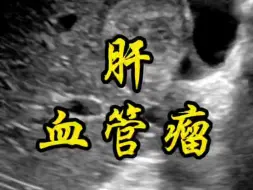 Descargar video: 肝血管瘤