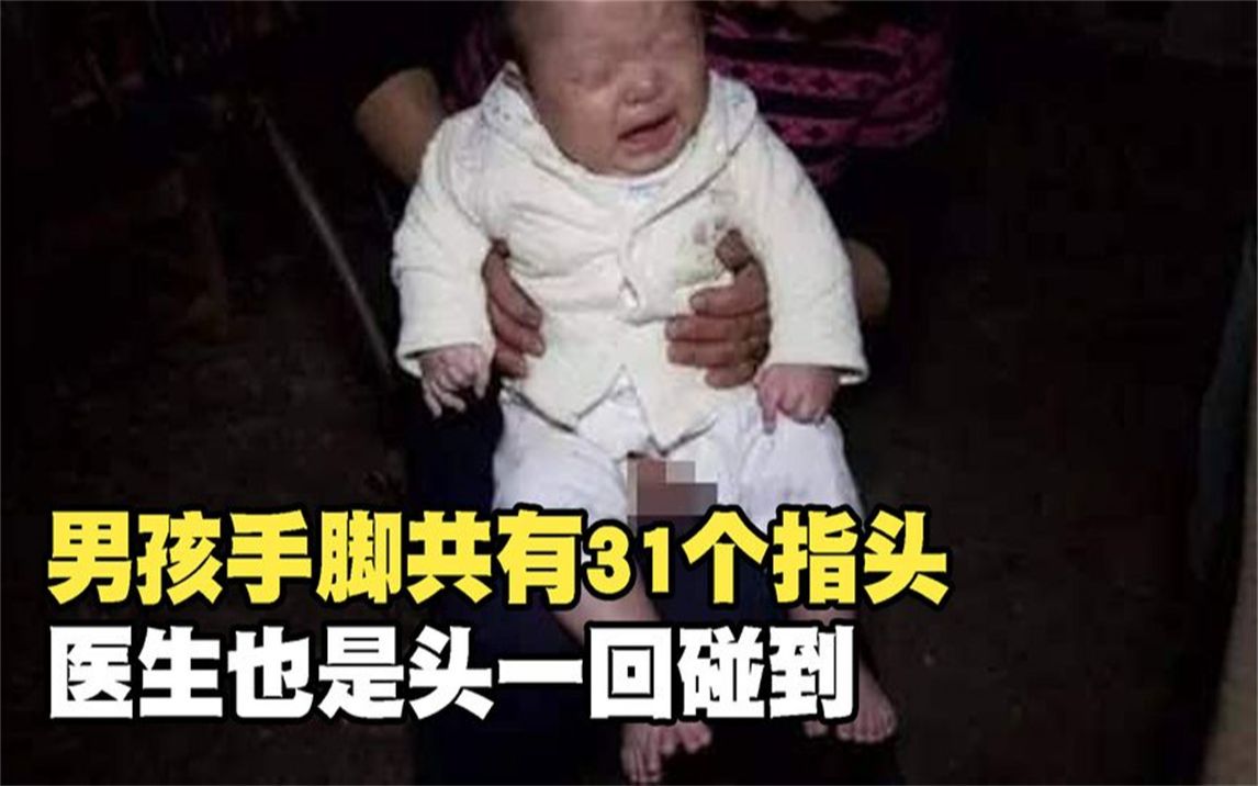 [图]男孩手脚共有31个指头，医生也是头一回碰到，难以下手