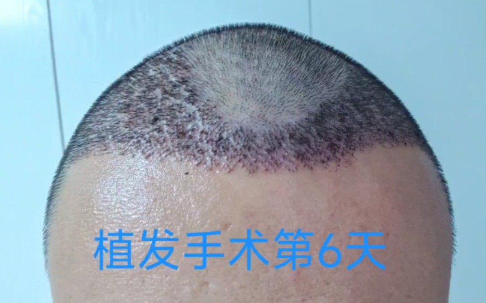 植发六天植发区痒怎么办(植发后怎么6天了还那么疼)