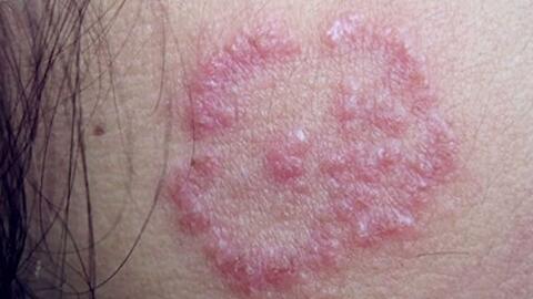 No112 长期撸猫身上起红斑发痒怎么办 哔哩哔哩