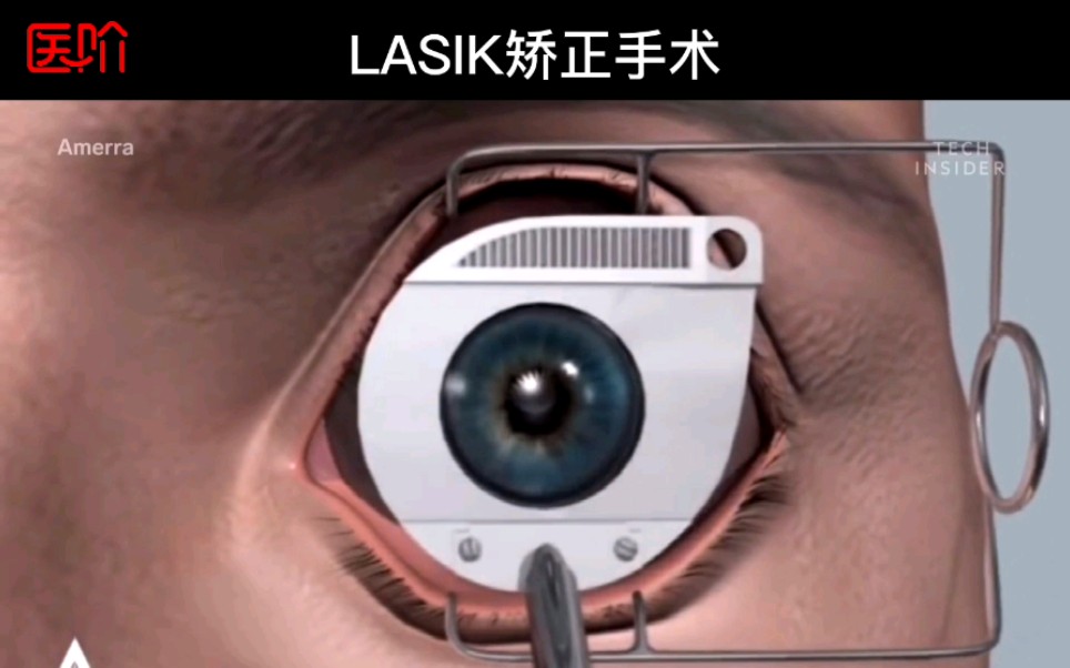 《八种手术简短介绍》,第五种:LASIK矫正手术.LASIK矫正手术主要是把角膜打薄,从而改变折光系统.手术后需要注意保护,注意用眼卫生.#近视哔...