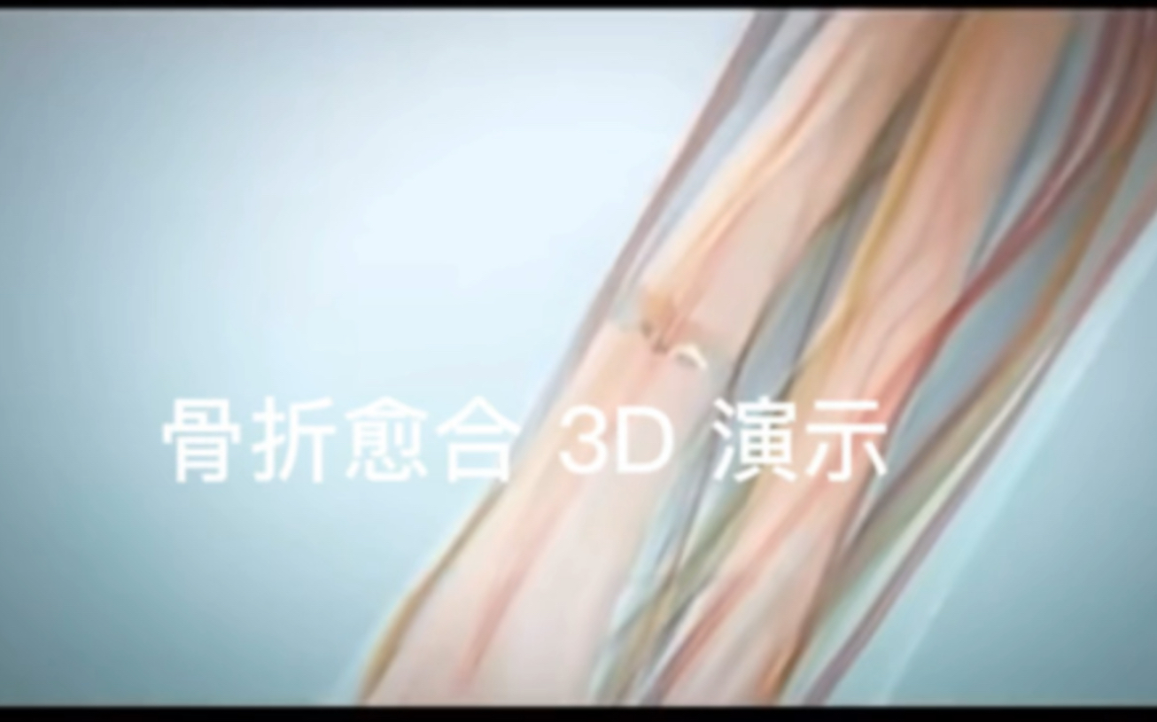 骨折愈合3D演示,4分半,让你感受人体的神秘和强大!哔哩哔哩bilibili