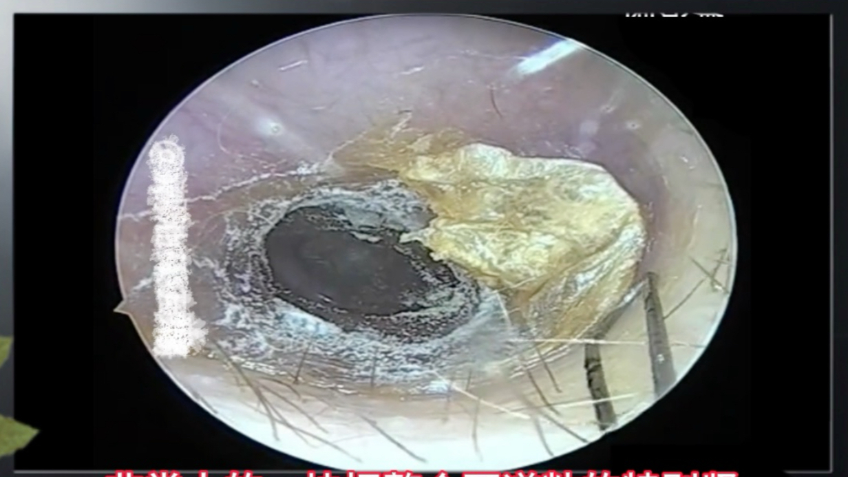 大二小姐姐的耳朵;整个耳道长满了霉菌,又疼又痒非常难受