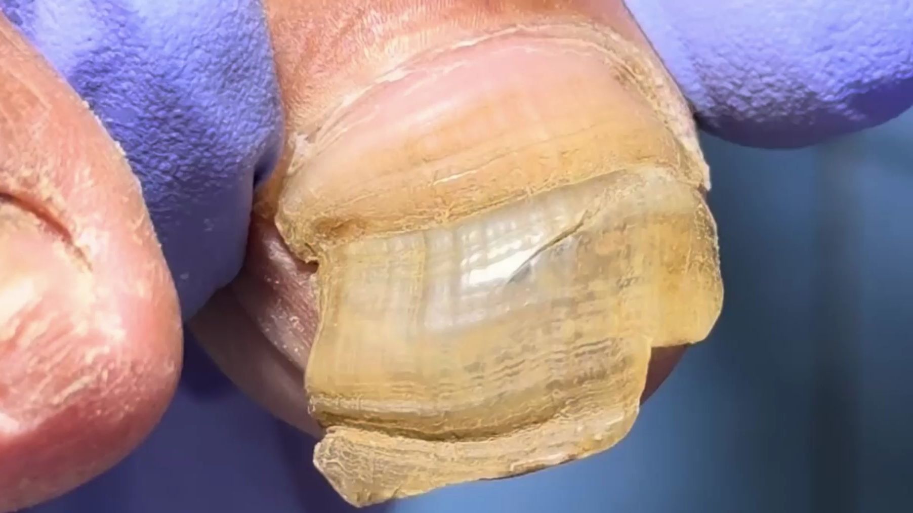 非常长的脏指甲!修剪后仍有大量黑泥