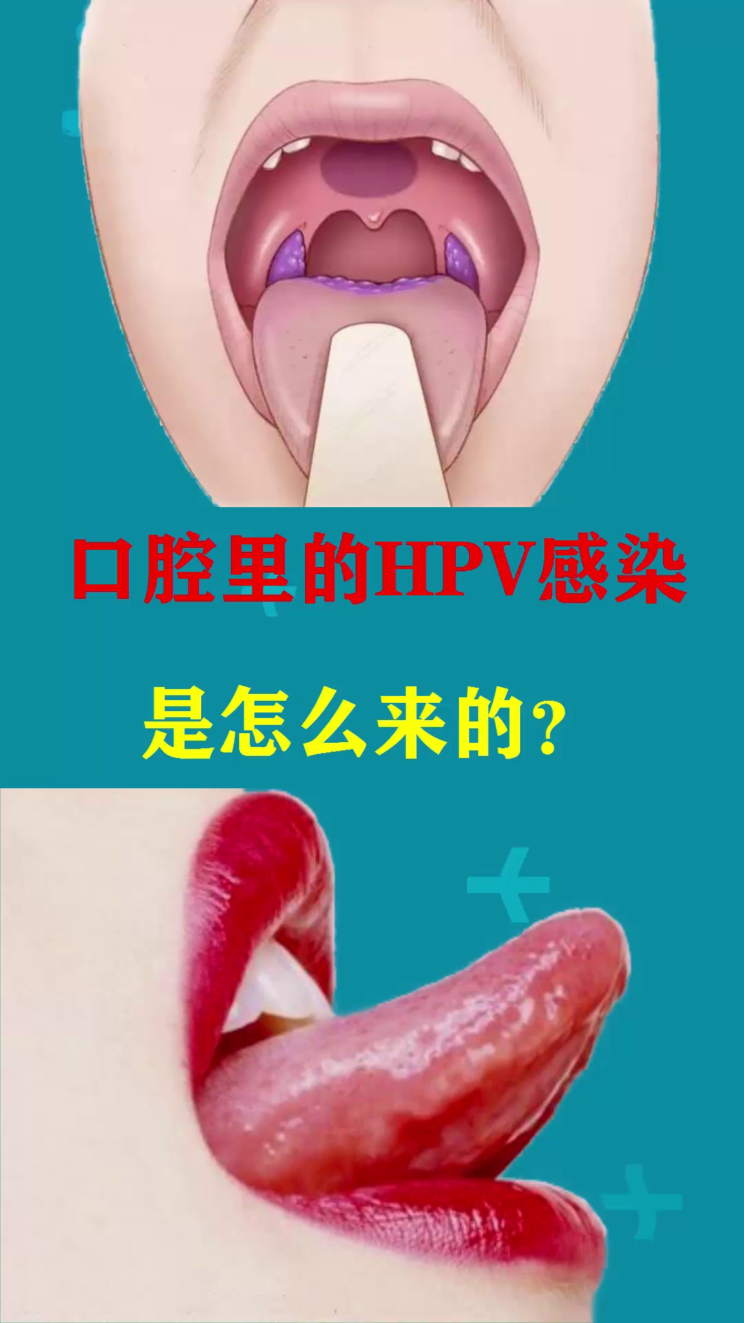 口腔里的hpv感染是怎么来的?说出来你可能不信...哔哩哔哩bilibili