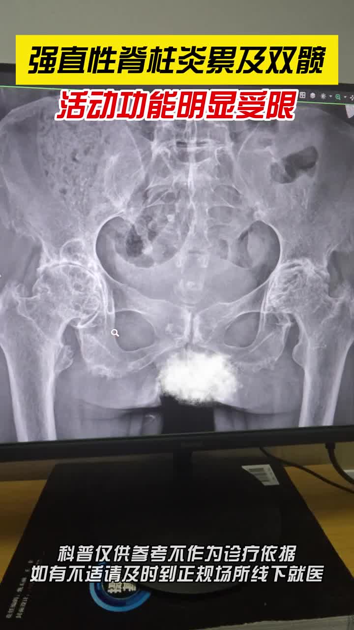 强直性脊柱炎累及双髋,活动受限!