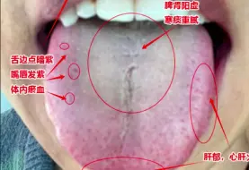 下载视频: 这种肝郁脾虚舌头，千万别去疏肝、健脾、补阳，吃再多的各种丸也是白搭！