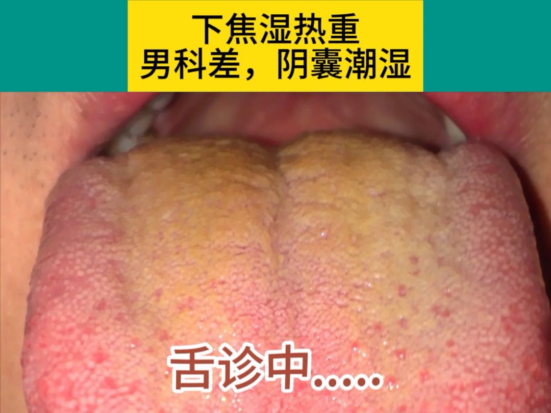 下焦湿热,男科差,阴囊潮湿