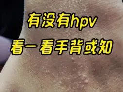 Download Video: 有没有hpv，看一眼手背或知道