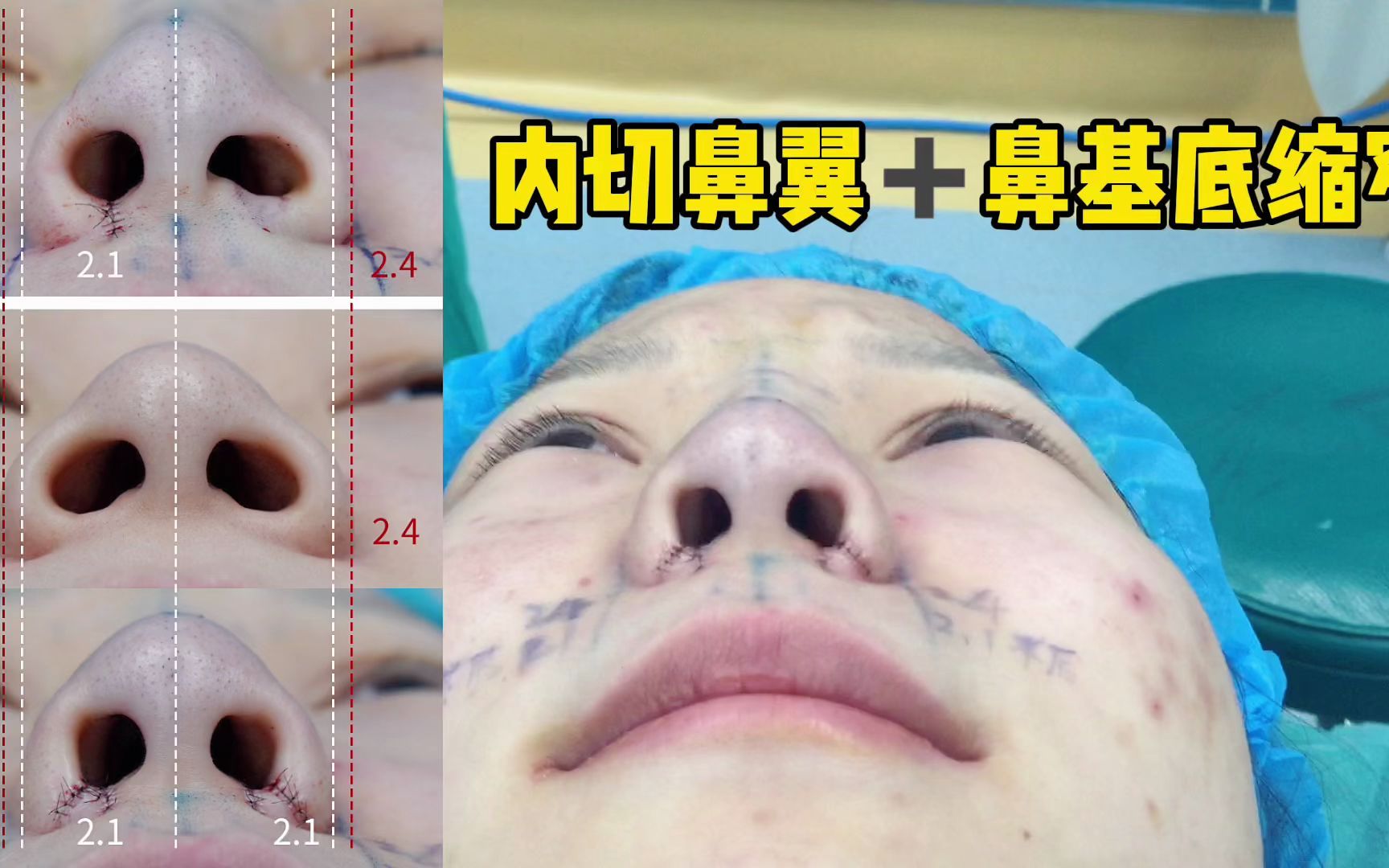 内切鼻翼 鼻基底缩窄