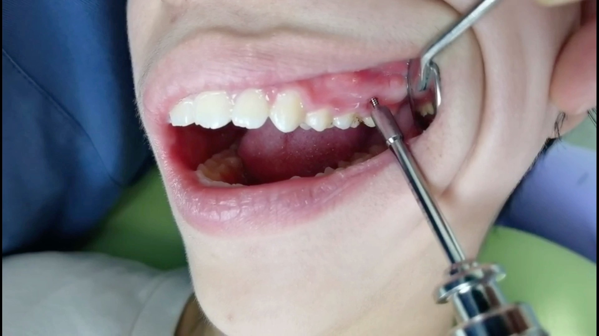 牙齿矫正之取支抗钉