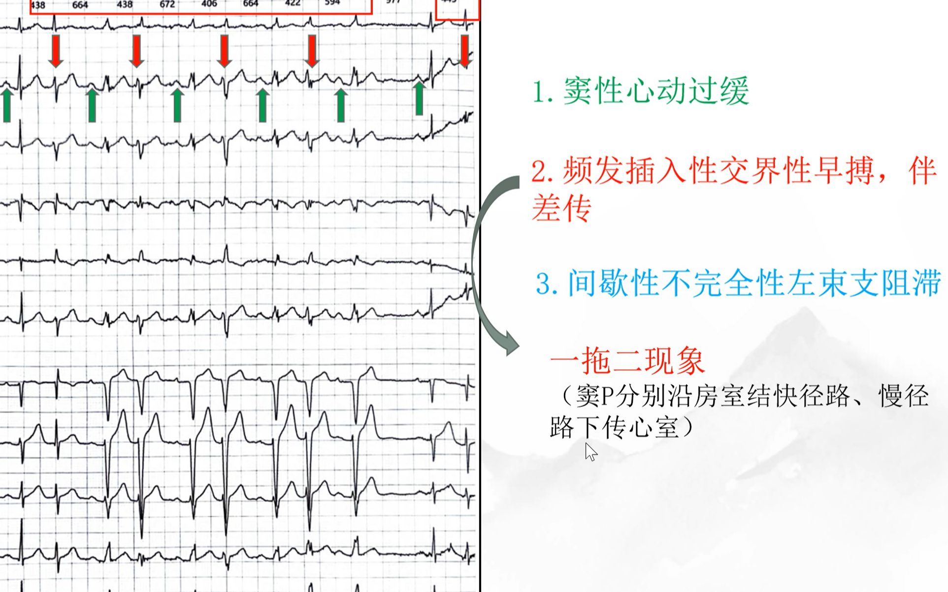 房室结双径路1《房性反复搏动,一拖二现象(双重心室反应)》哔哩哔哩bilibili