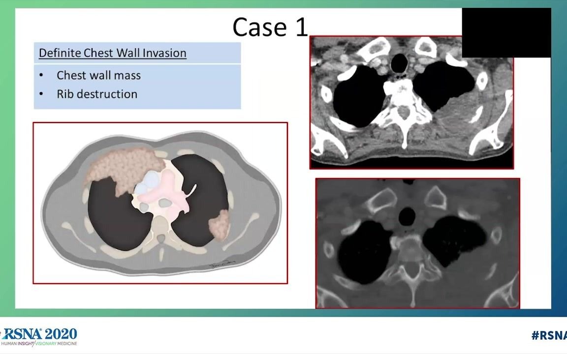 (肺、纵隔、胸膜病例MDT)BOOST Lung, Mediastinum, Pleura—Casebased MDT Review哔哩哔哩bilibili