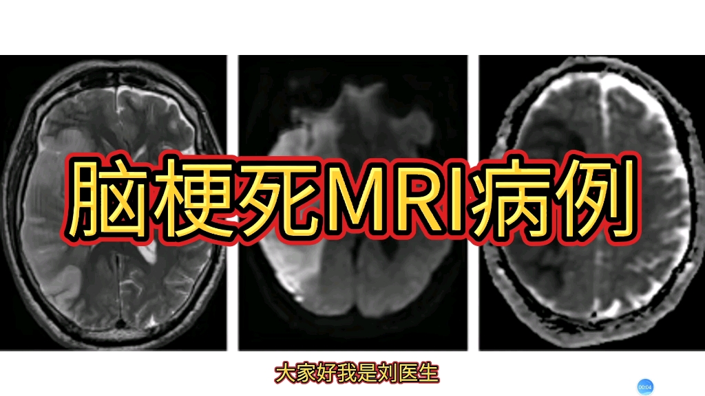 一例急性脑梗死mri病例分享,诊断要点总结!