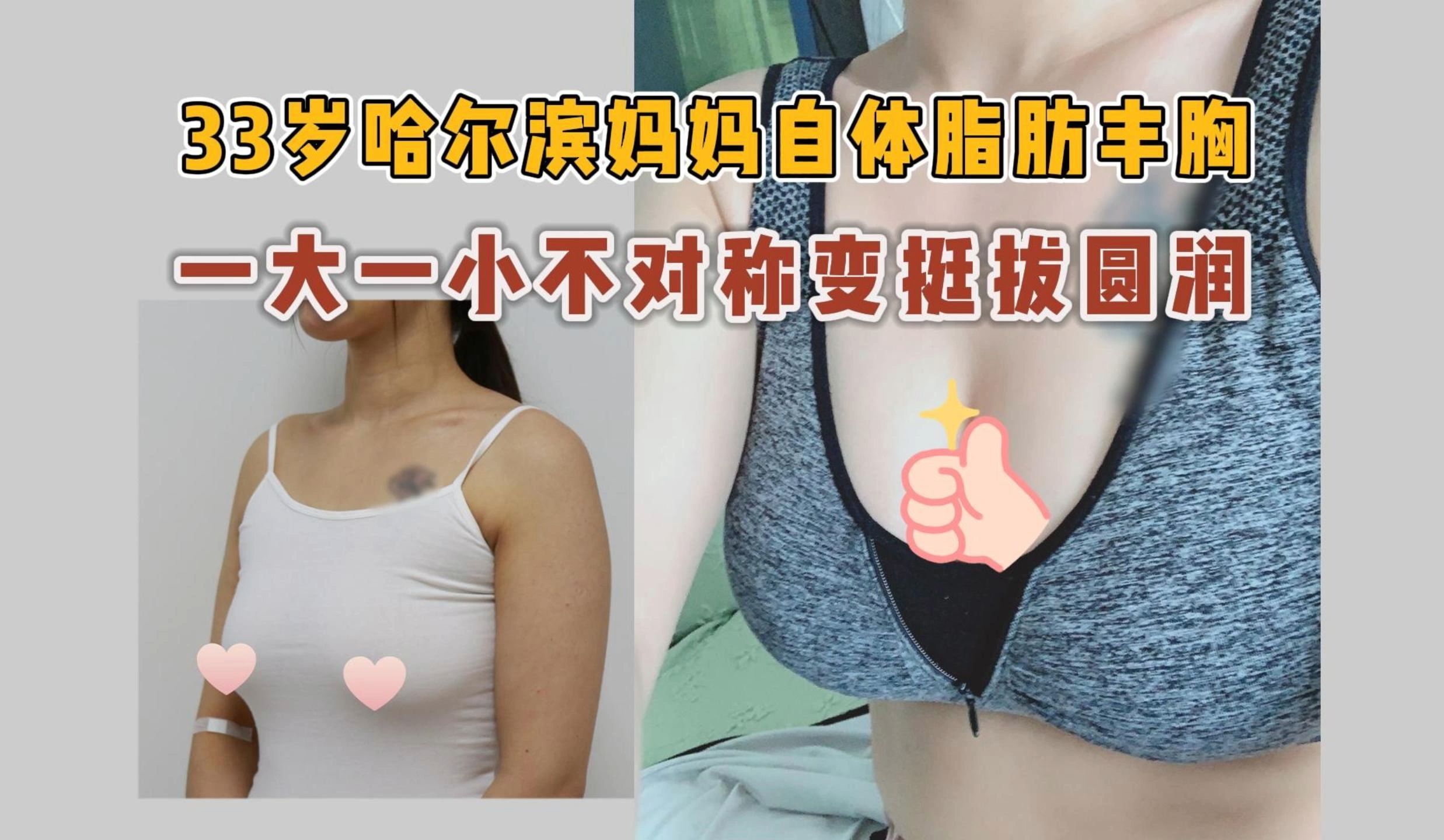 【李春财】33岁的家庭主妇王女士,哺乳后胸部一大一小不对称,选择自体脂肪填充,来看看她的经历吧哔哩哔哩bilibili