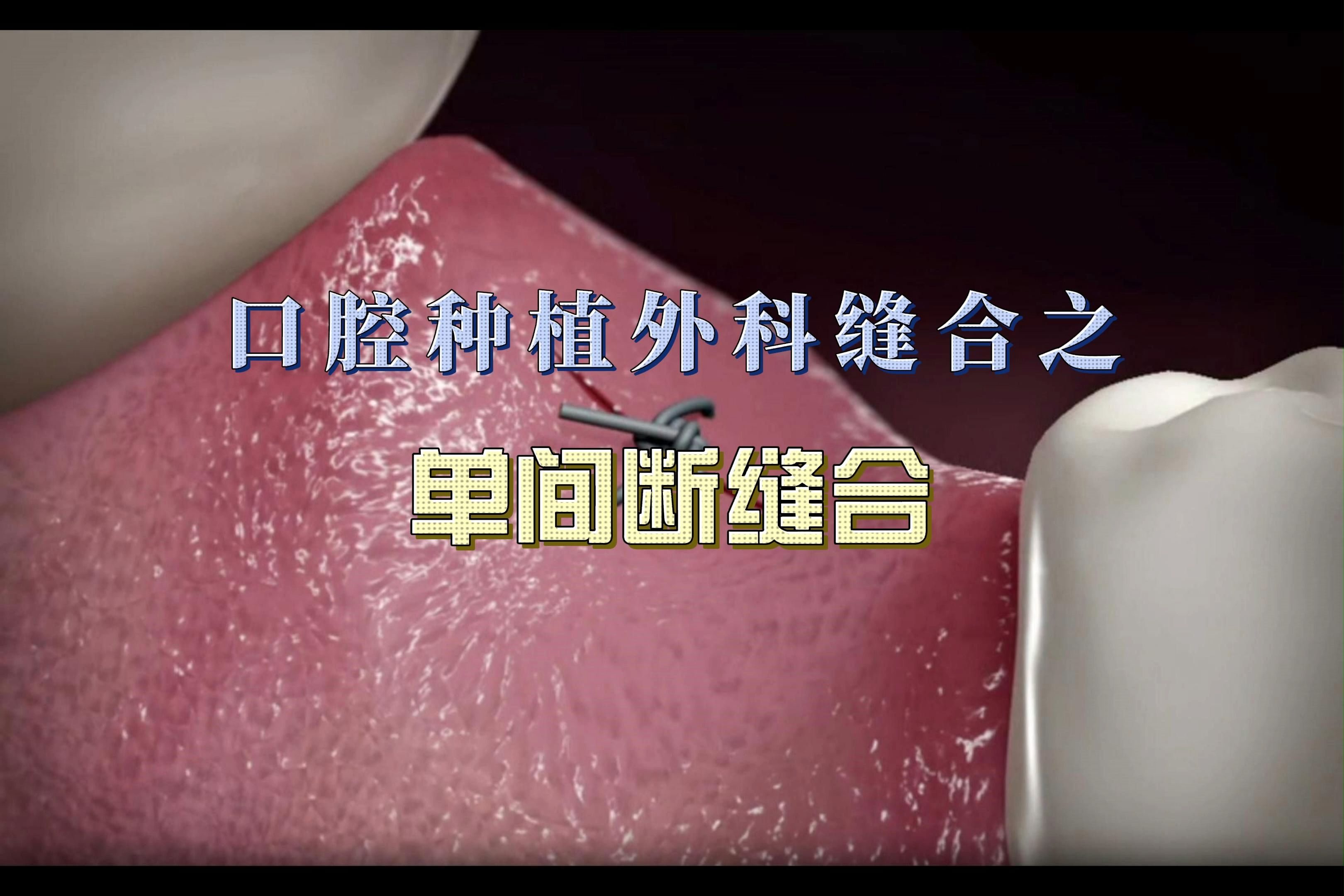 口腔种植外科缝合之单间断缝合