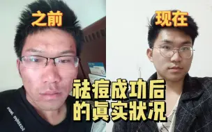 Download Video: 五次点阵激光后，我的皮肤最真实的恢复情况，十年祛痘史《云亭北vlog》